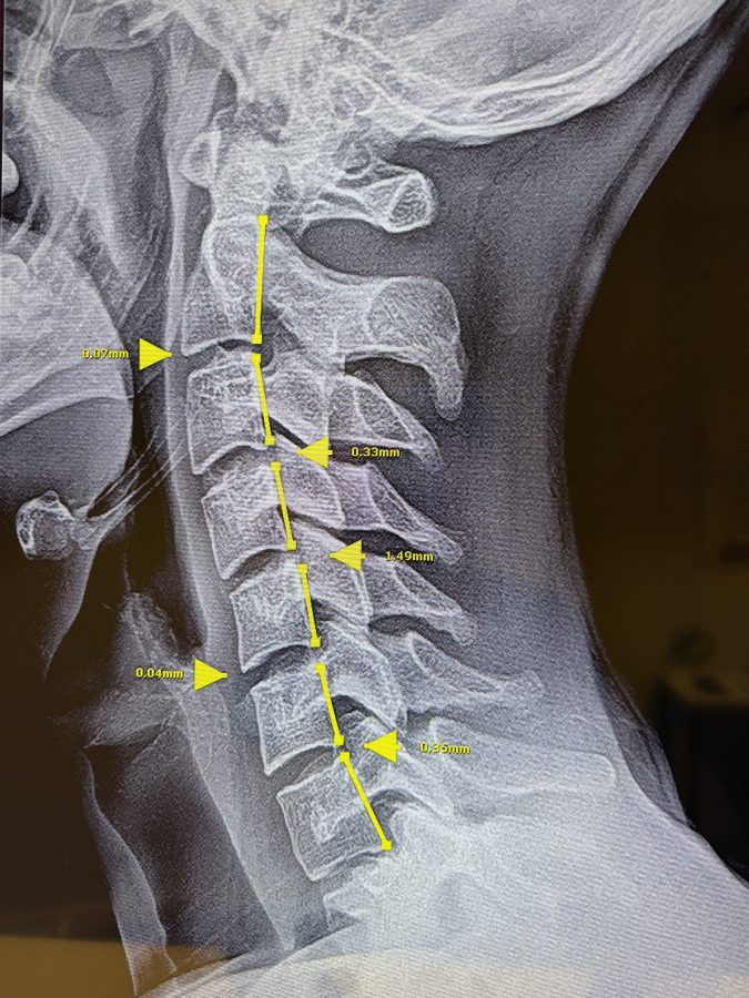 spinal xray showing reduced curvature after chiropractic treatment
